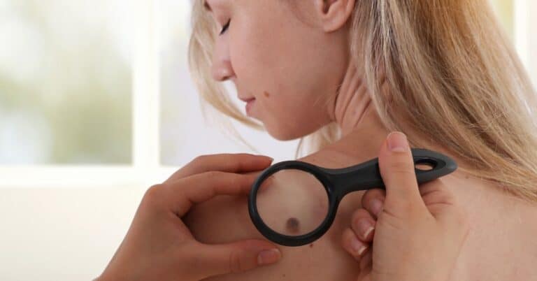 Skin Tags? How Safely Remove Them According To Dermatologists