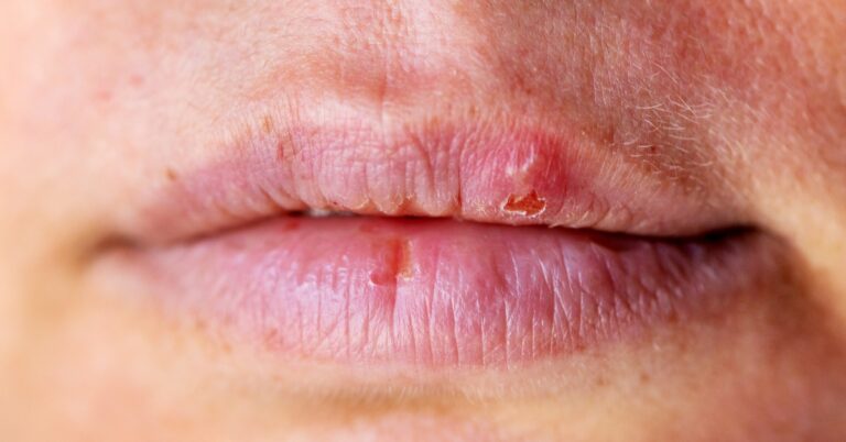 Home Remedy For Lip Blister