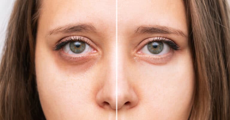 Best Vitamins For Dark Circles: Solutions For Under-Eye Shadows